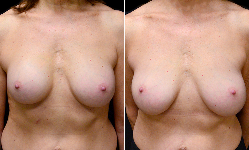 New Jersey Breast Implants Treatment Before And After