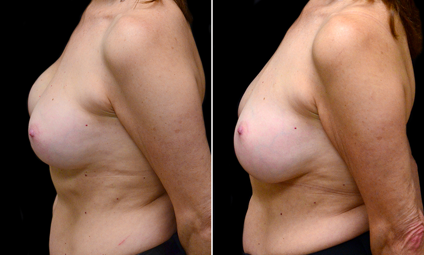New Jersey Breast Implants Surgery Results
