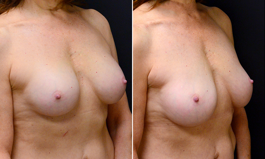 Before And After Breast Implants Surgery In New Jersey