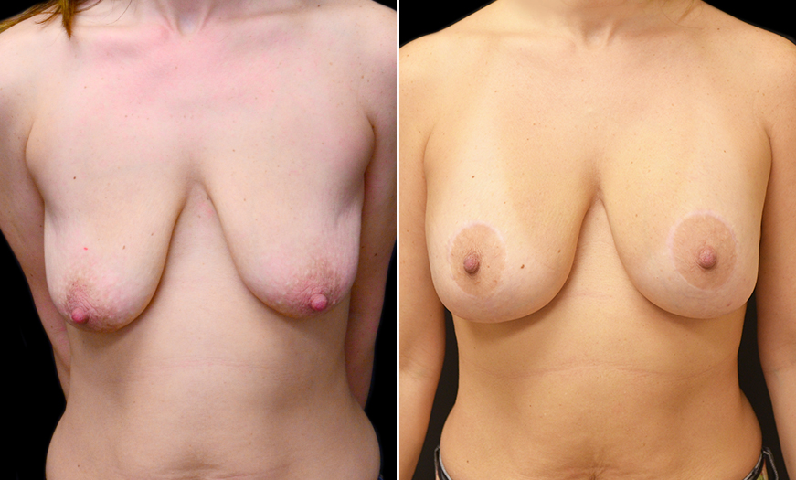 New Jersey Mastopexy Surgery Before And After 