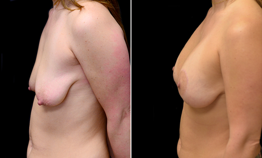 Before And After Mastopexy In New Jersey