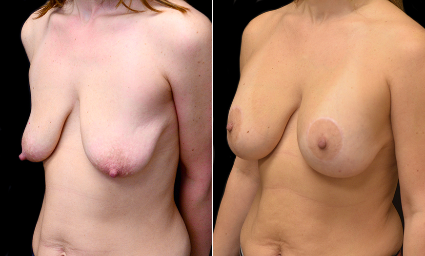 Mastopexy Results In New Jersey