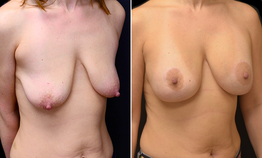 Mastopexy Before & After In New Jersey