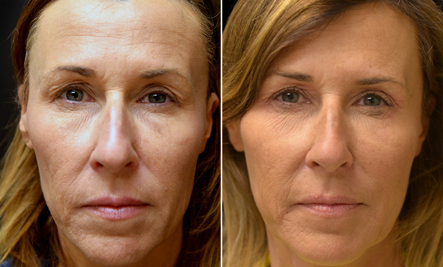 Upper Blepharoplasty, Ptosis Repair, And Botox Fillers In New Jersey