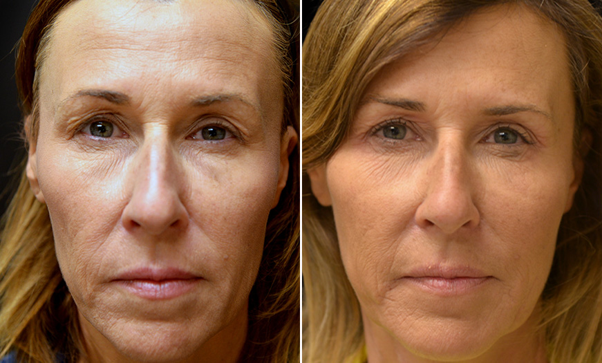 New Jersey Blepharoplasty Before and After