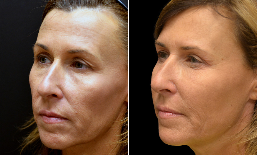 New Jersey Blepharoplasty Before and After