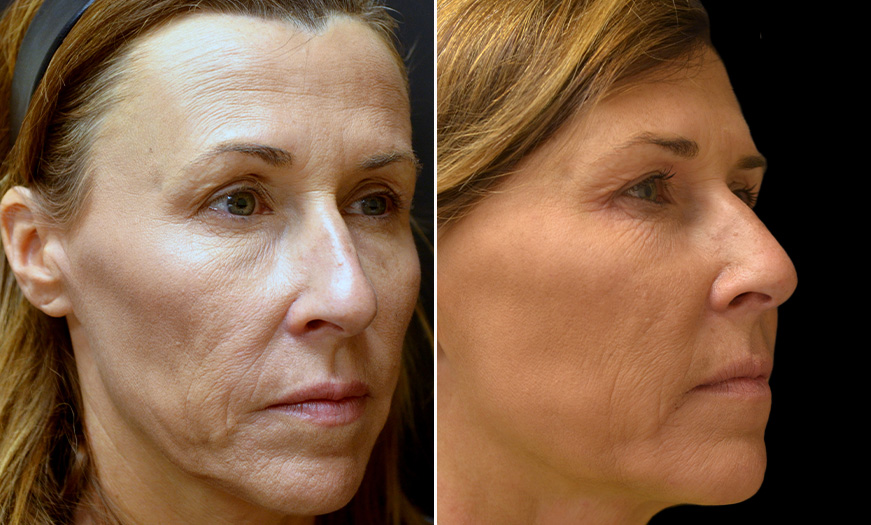 Blepharoplasty Before & After In New Jersey