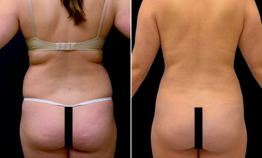 VASER Liposelection in New Jersey