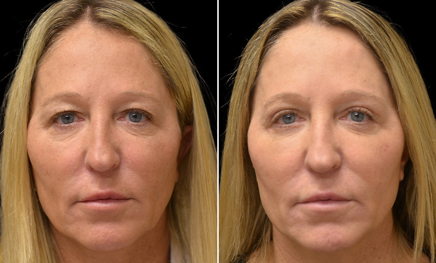 Blepharoplasty Surgery Results In New Jersey