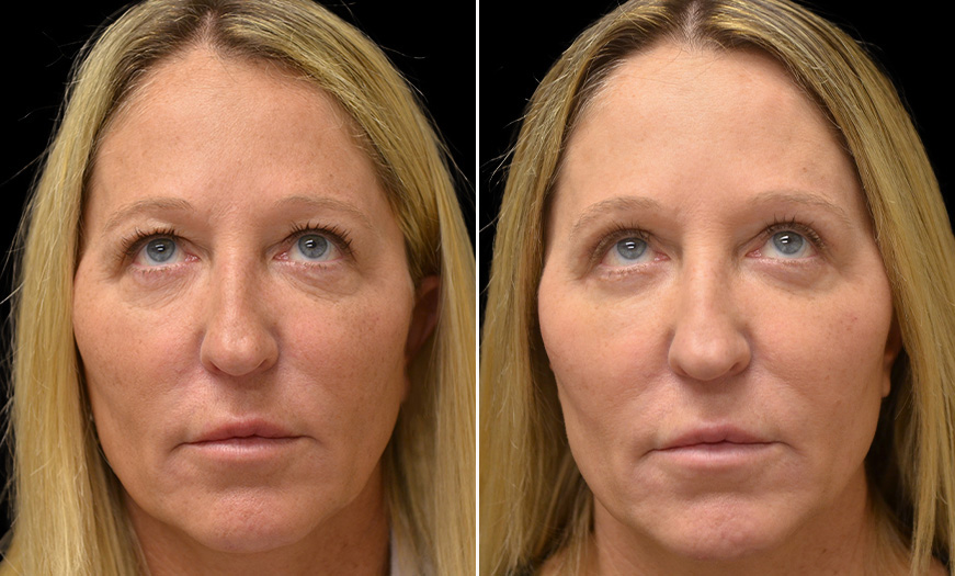 Blepharoplasty Results In New Jersey