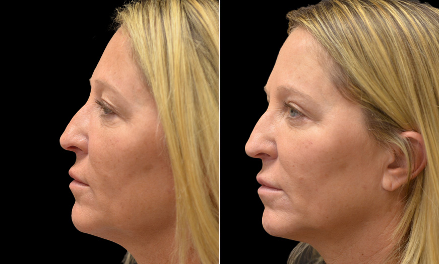Eyelid Surgery Before & After In New Jersey