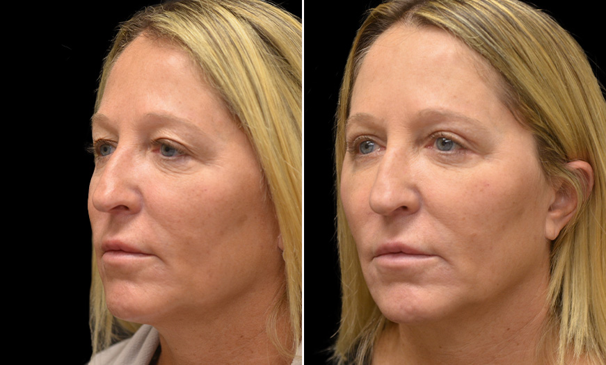Eyelid Surgery Before And After New Jersey