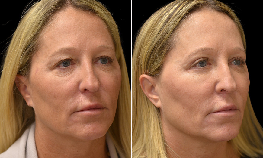 Eyelid Lift Before And After In New Jersey
