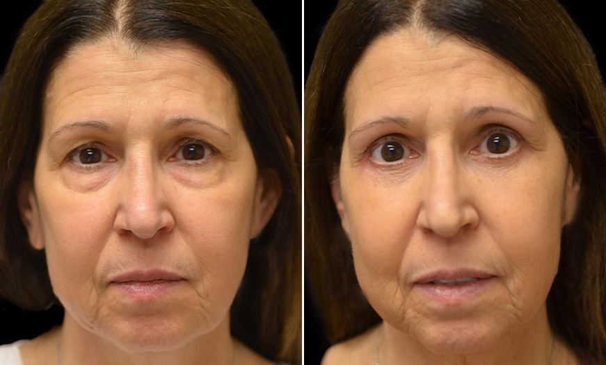 Upper Eyelid Blepharoplasty Before And After In New Jersey