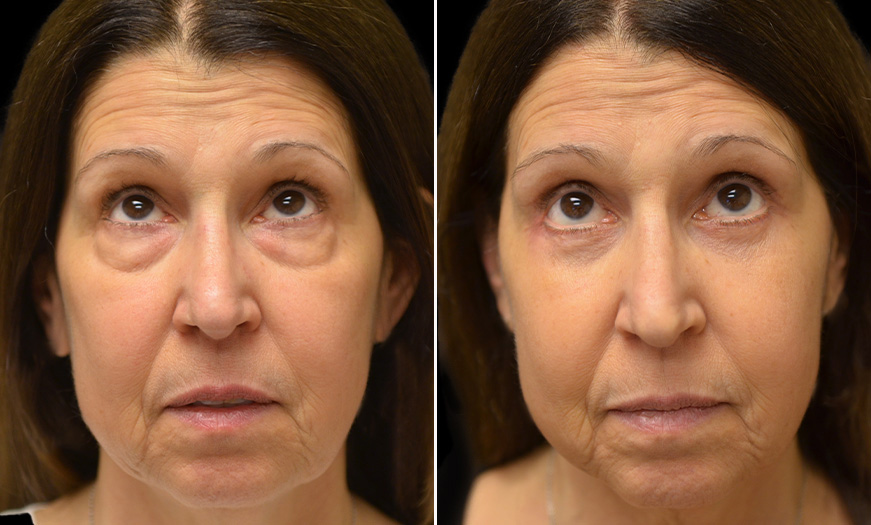 Before And After Blepharoplasty Surgery In New Jersey