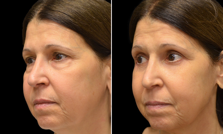 Blepharoplasty Before And After In New Jersey