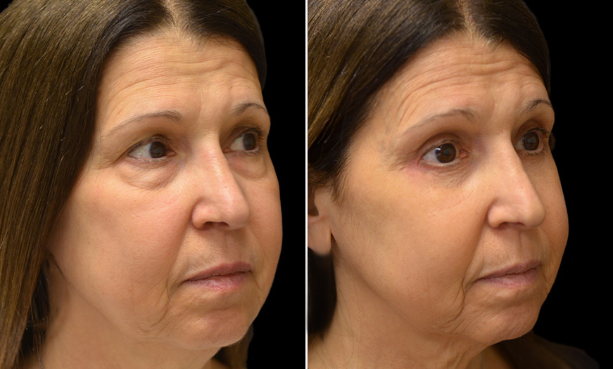 Before And After Eyelid Surgery In New Jersey