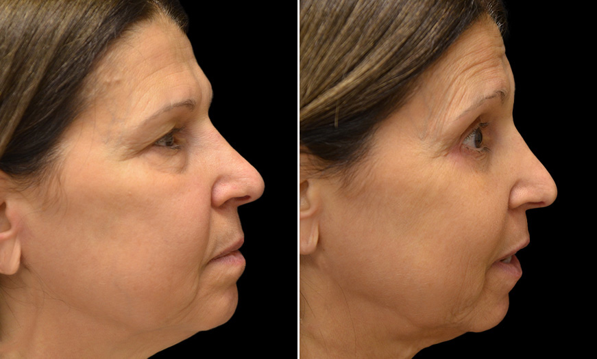 Blepharoplasty Results In New Jersey