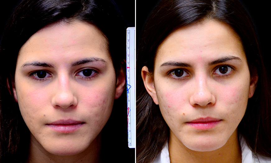 Rhinoplasty Treatment Before And After In New Jersey