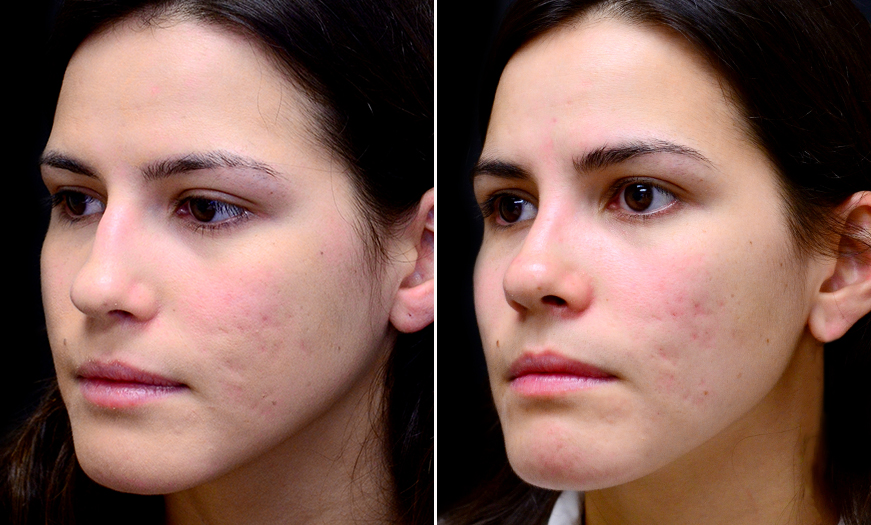 Before And After Rhinoplasty Surgery In New Jersey