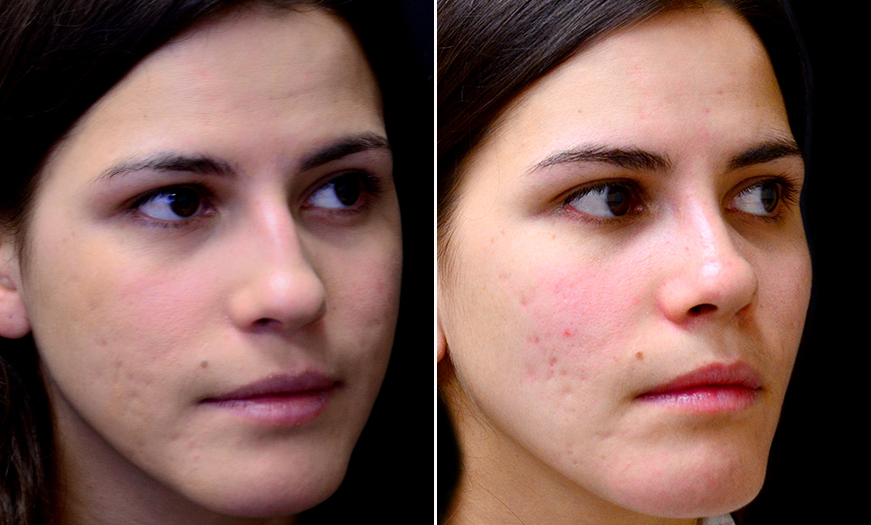 Rhinoplasty Surgery Before & After In New Jersey
