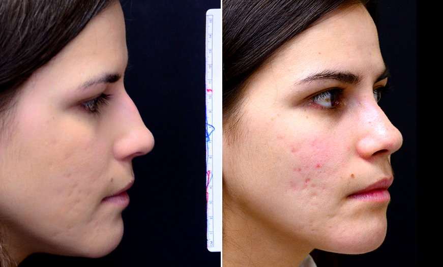 Rhinoplasty Surgery Before And After In New Jersey