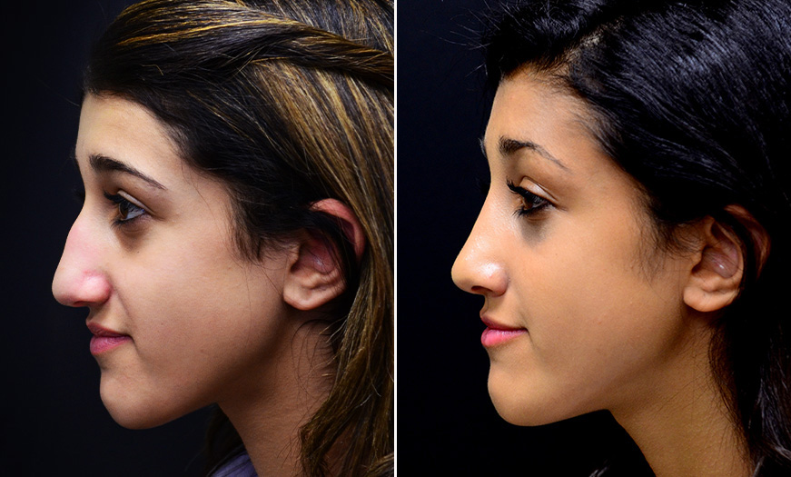 Before And After Rhinoplasty With Dr. Asaadi