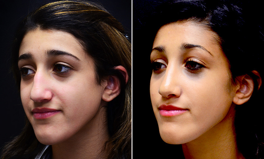 Before & After Rhinoplasty Treatment In New Jersey