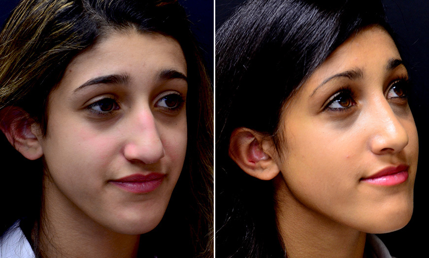 Before And After Rhinoplasty Treatment In New Jersey