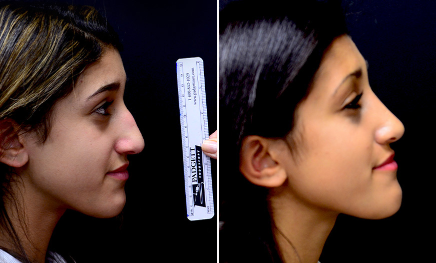 Rhinoplasty Treatment Before & After In New Jersey