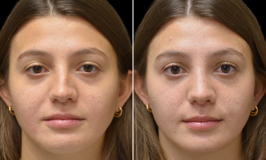 Before And After Rhinoplasty Treatment With Dr. Asaadi
