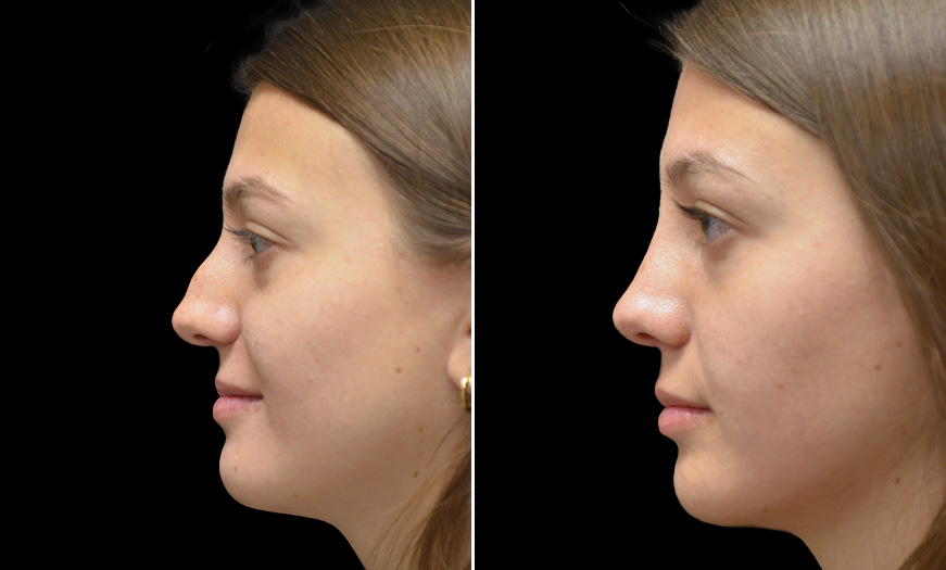 Before And After Rhinoplasty Surgery With Dr. Asaadi