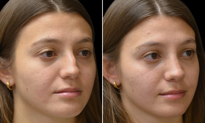 Before & After Rhinoplasty Surgery With Dr. Asaadi