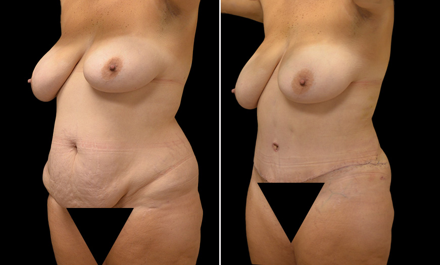 Core Abdominoplasty Results