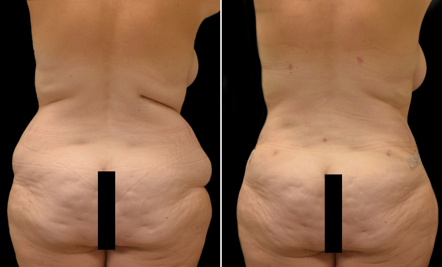 Before & After Core Abdominoplasty New Jersey