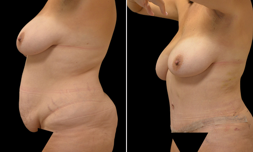 Before And After Core Abdominoplasty New Jersey