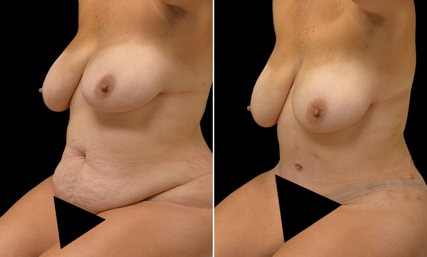 VASER Lipo NJ Before & After