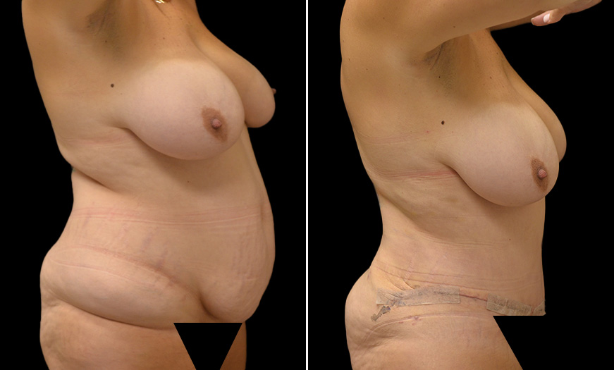 Tummy Tuck & Vaser Lipo Side View Results