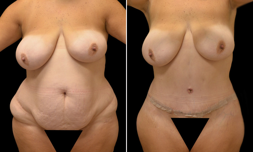 Excess Skin Removal Before & After