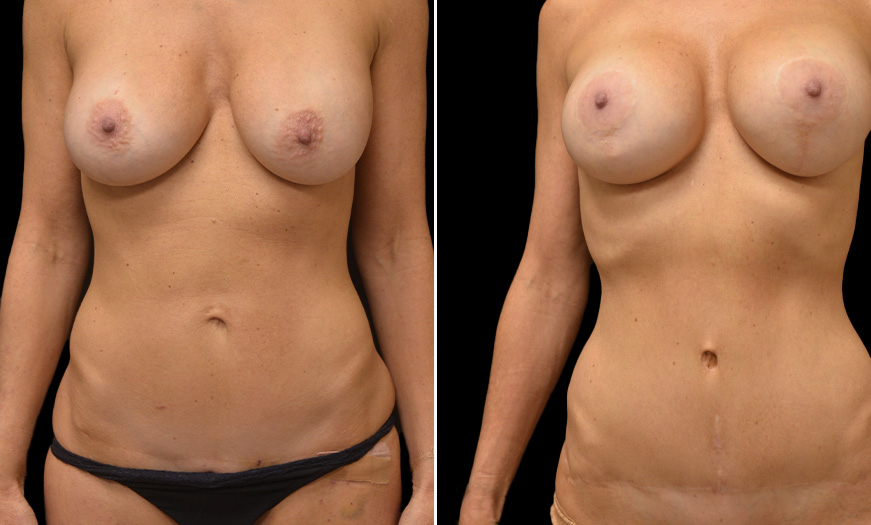 Results Of Core Abdominoplasty NJ Front View 