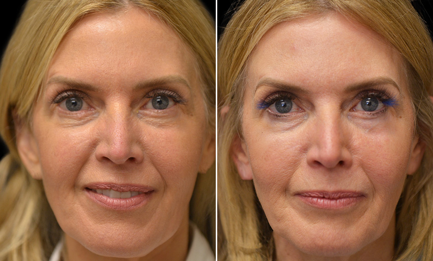 Lower Blepharoplasty Before and After Gallery