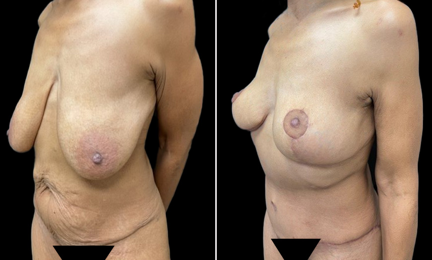Abdominoplasty Quarter Left View Before & After