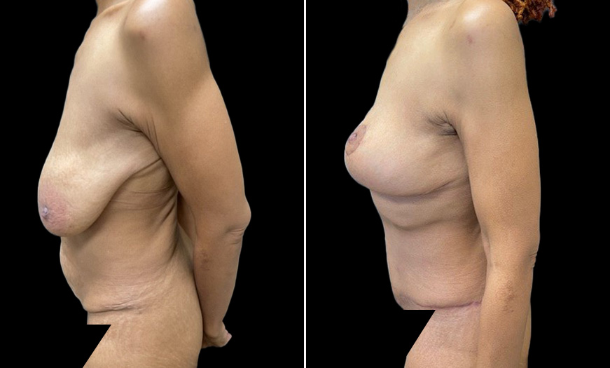 Abdominoplasty Before and After