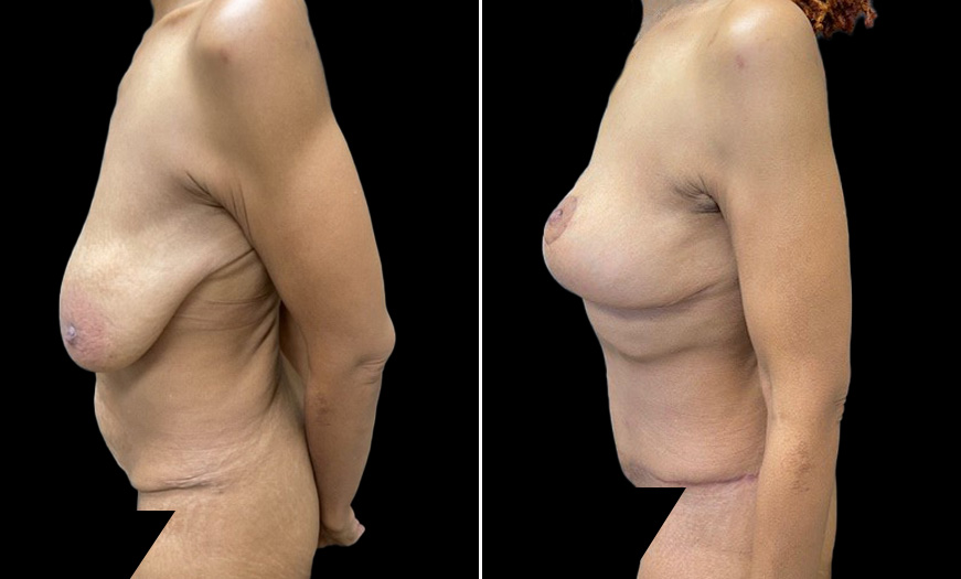 Breast Lift Before & After Side Left View NJ