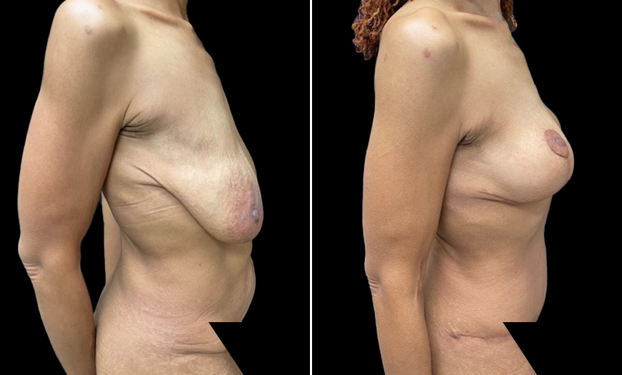 Breast Lift Before & After Side Right View NJ