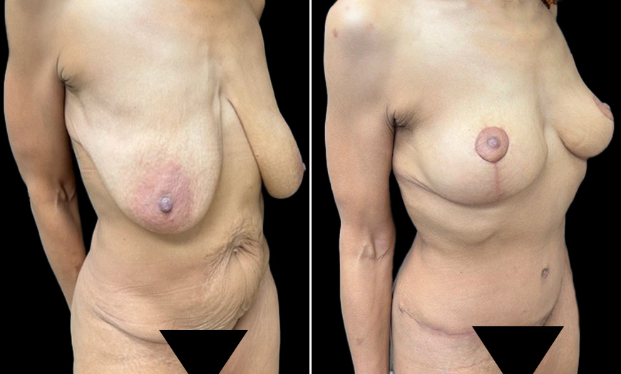 Breast Lift Before & After Quater Right View NJ