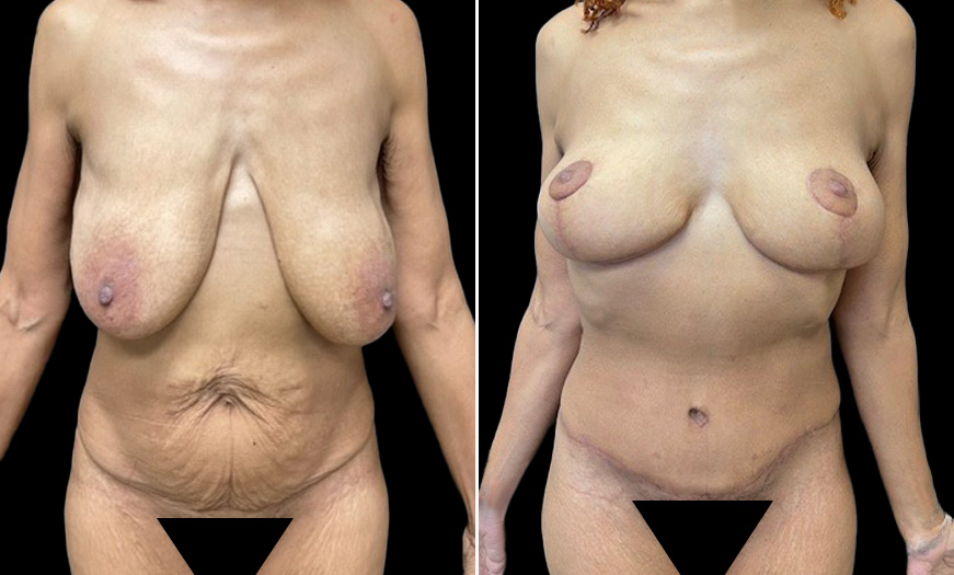 Abdominoplasty & Mastopexy Results