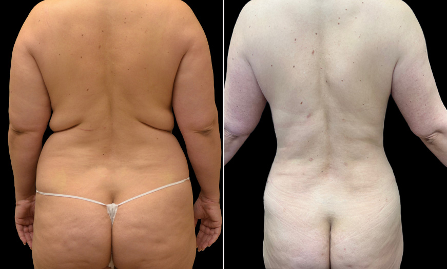 Abdominoplasty Before & After Results 