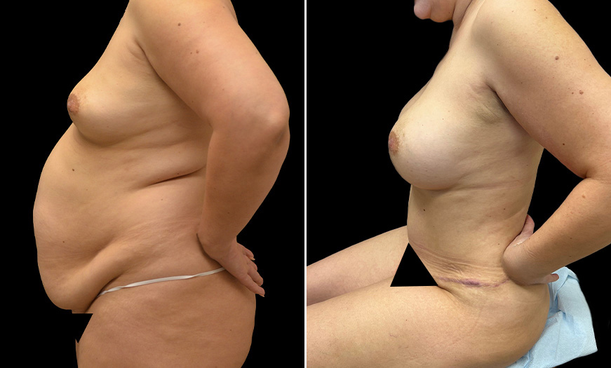 Breast Augmentation Results NJ