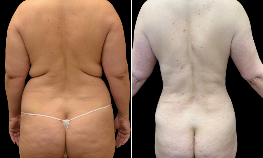 NJ VASER LipoSelection Back View Before & After